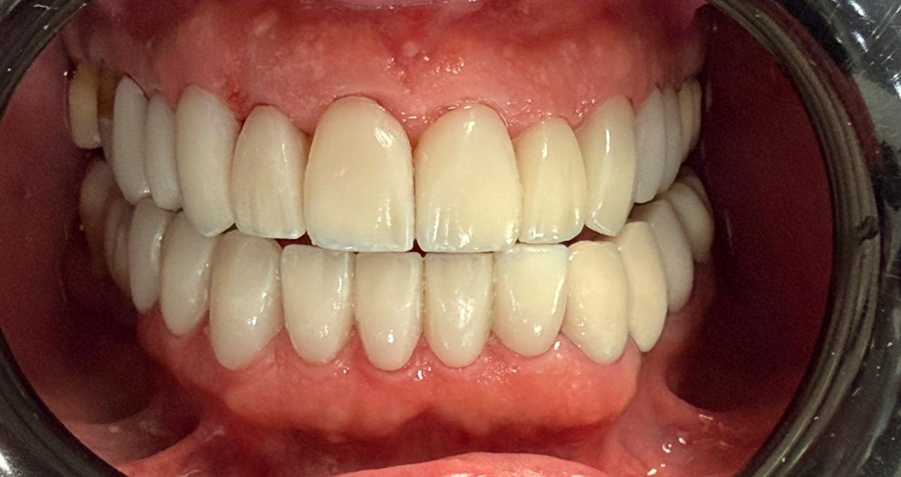 Diseño de sonrisa en disilicato de litio